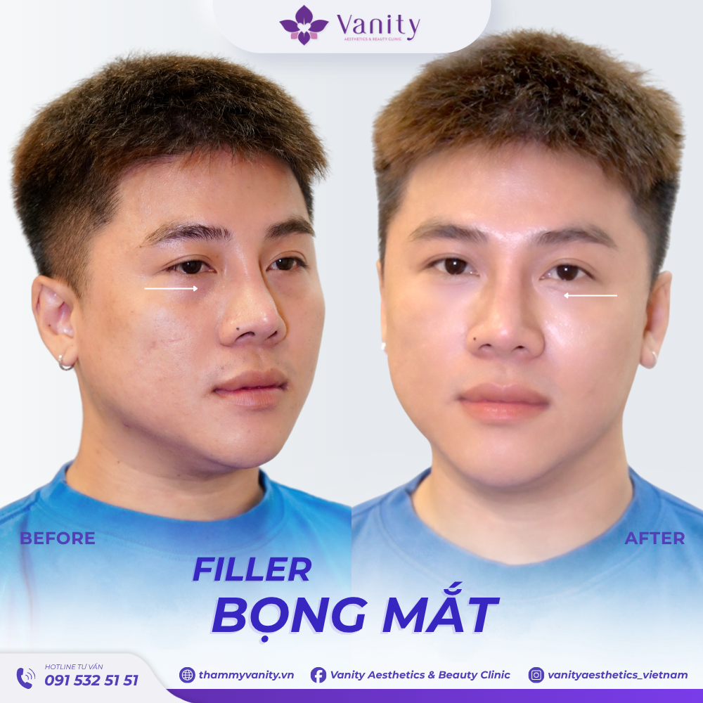 FILLER BỌNG MẮT